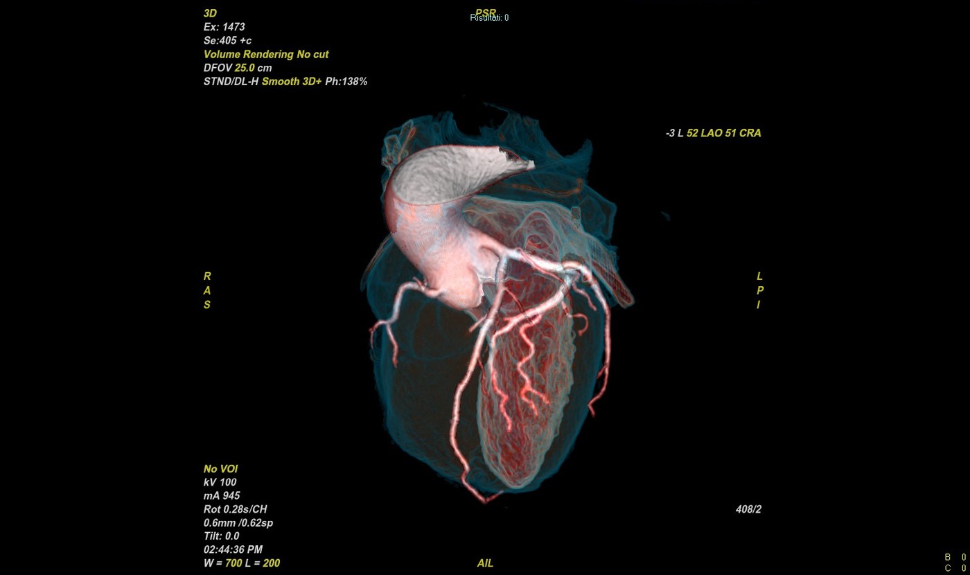 Ricostruzione 3D del cuore e delle coronarie