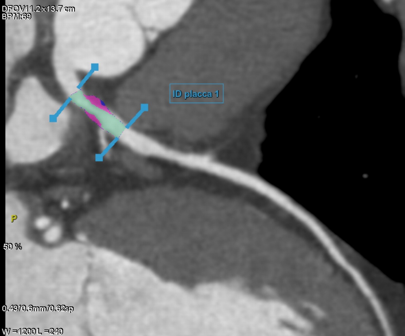 Analisi della placca alla coronarografia TC