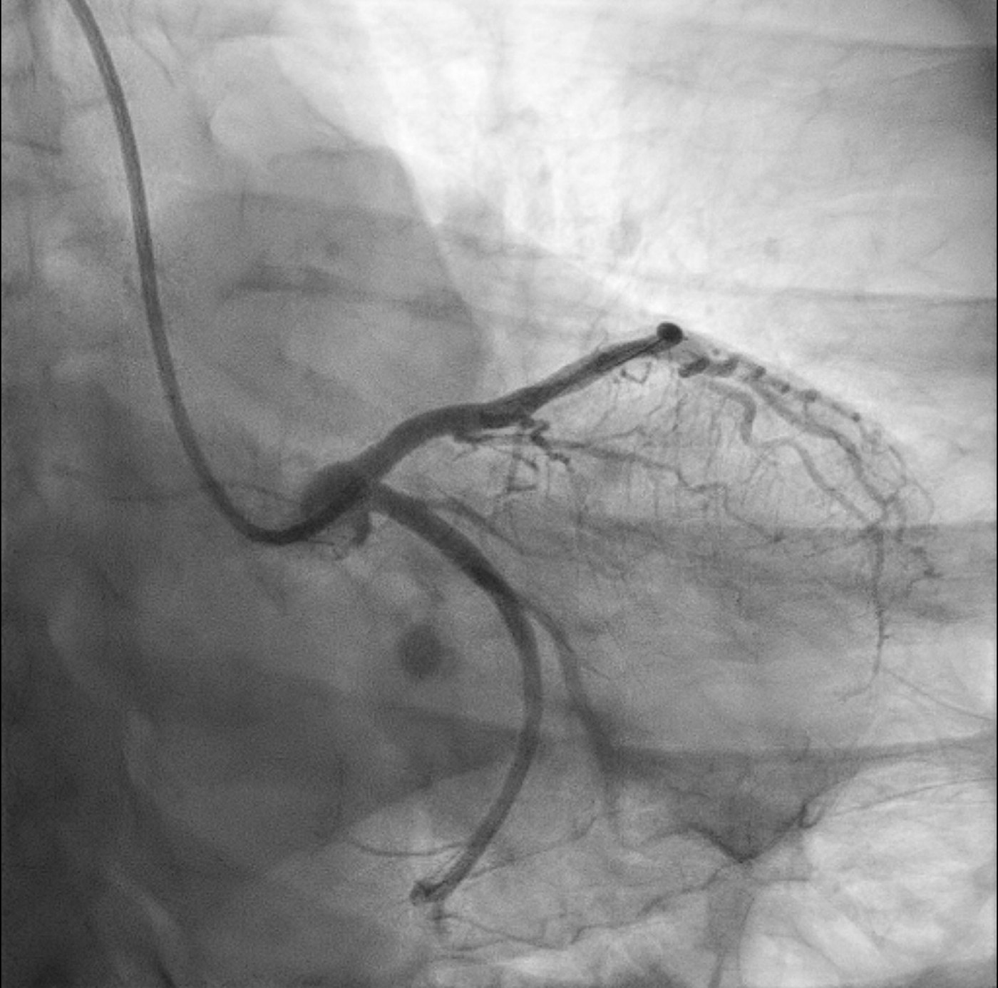 Coronarografia invasiva dopo l’impianto di stent