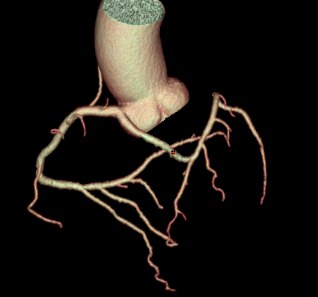 Coronaria unica, ricostruzione 3D